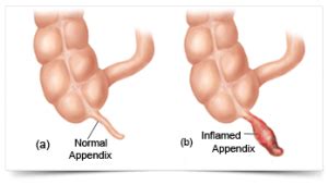 Why do doctors wait to remove appendix?